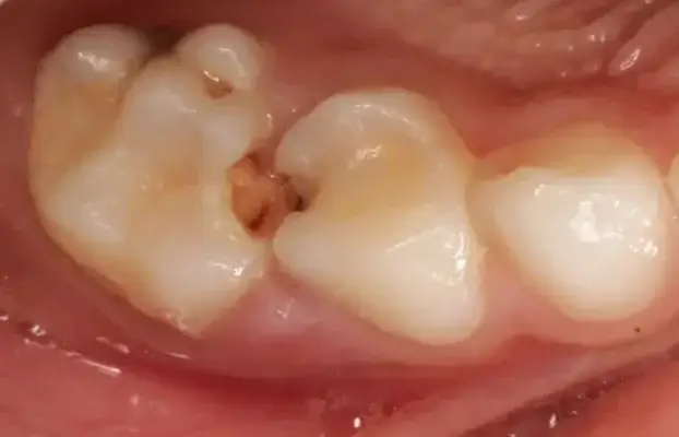 Class 2 Caries And Their Restoration