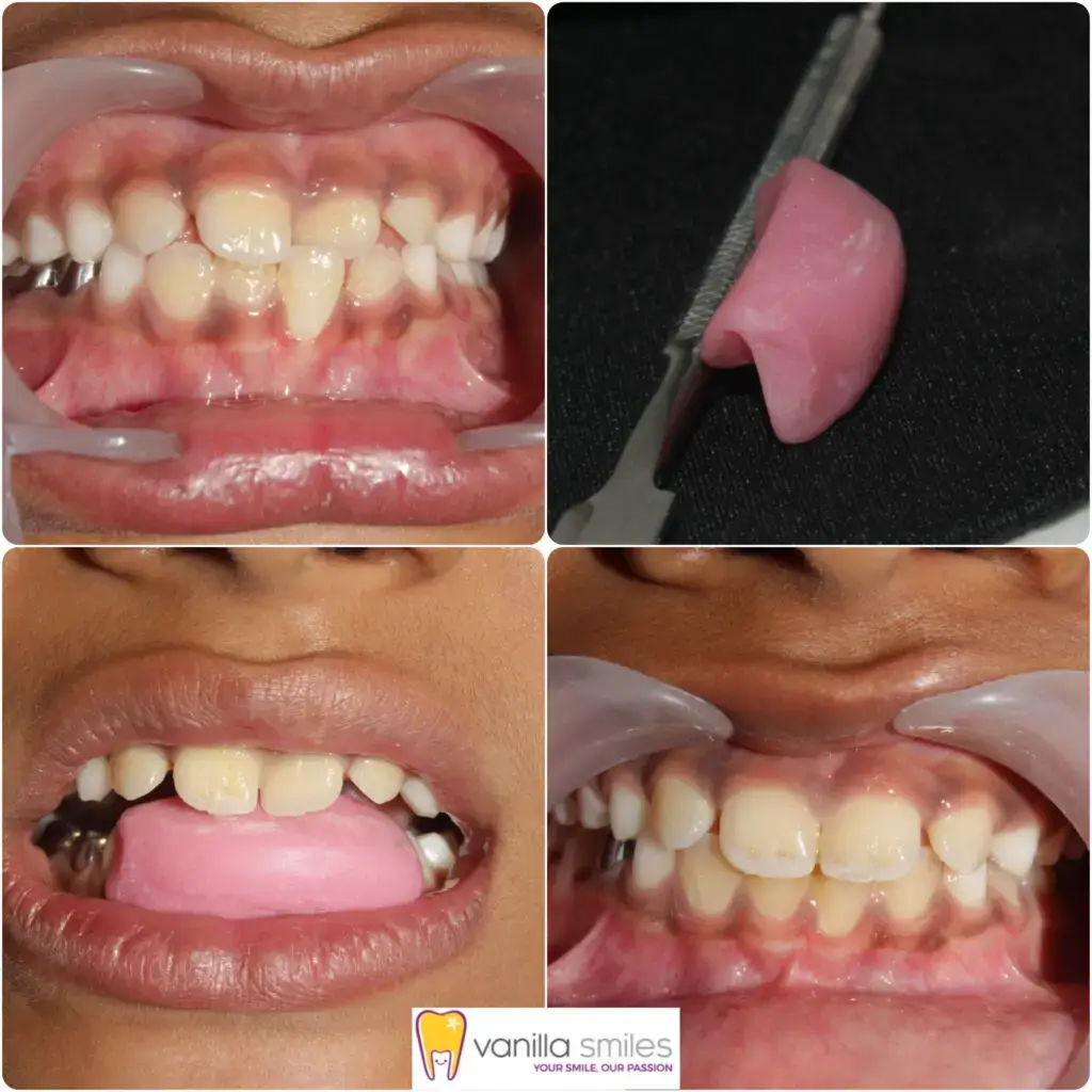 teeth solution by vanilla smiles