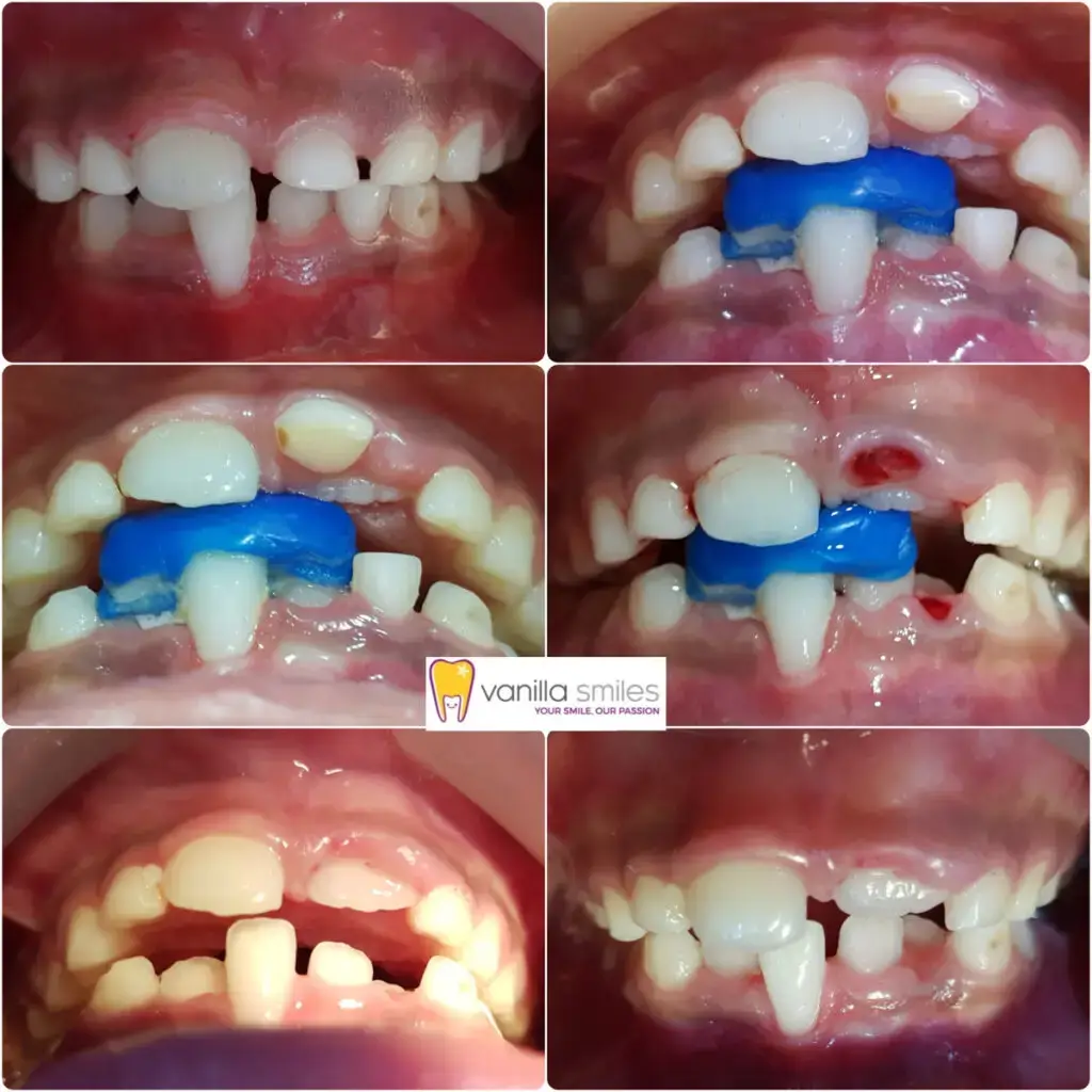 Teeth op problem with solution