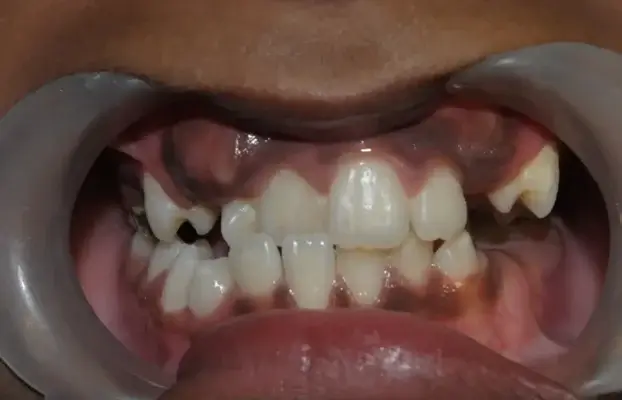 Anterior Cross Bite – Overview, Effect & Treatment