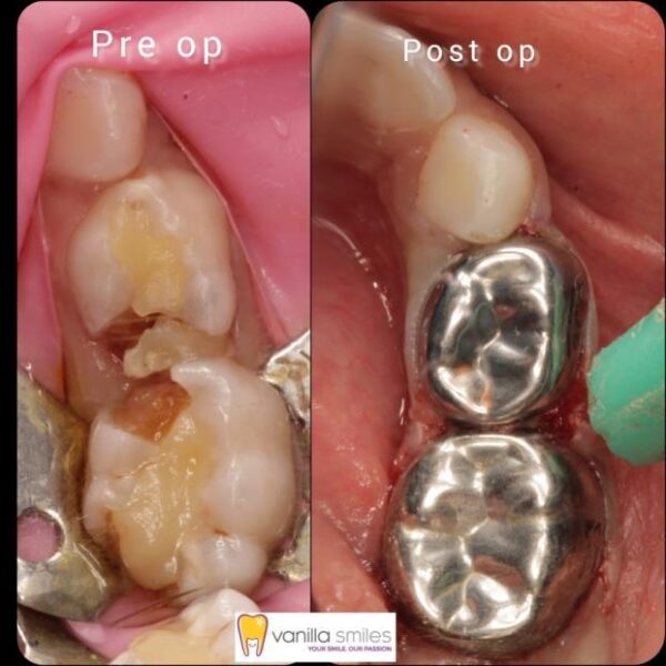 class 3 caries restoration