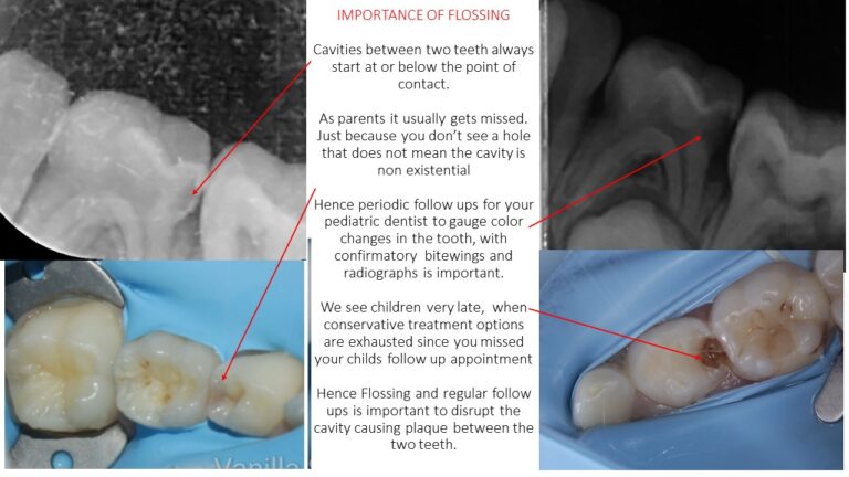 Class 2 Caries And Their Restoration - Vanilla Smiles Dental Clinic