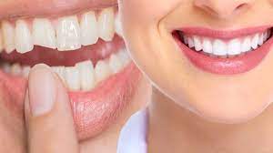 teeth cleaning and Teeth scaling in Pune
