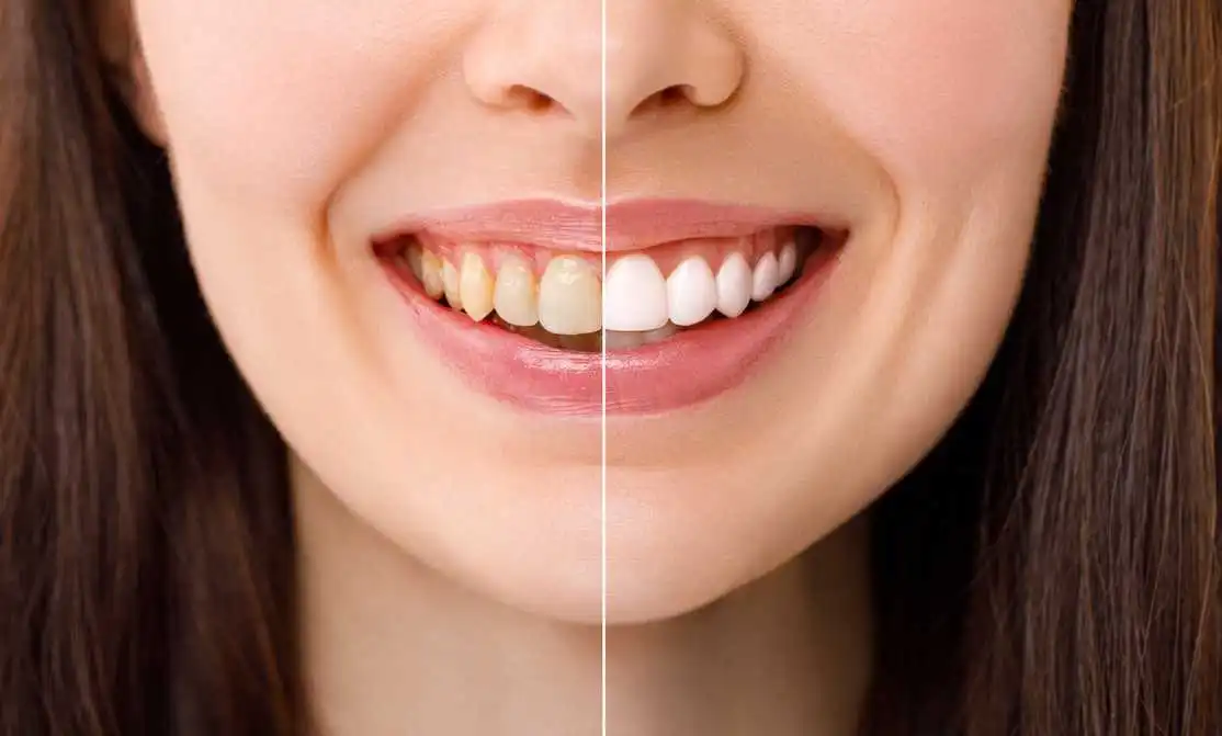 The Latest Trends in Teeth Whitening: Safe and Effective Solutions at Vanilla Smiles Dental Clinic in Shivaji Nagar, Pune