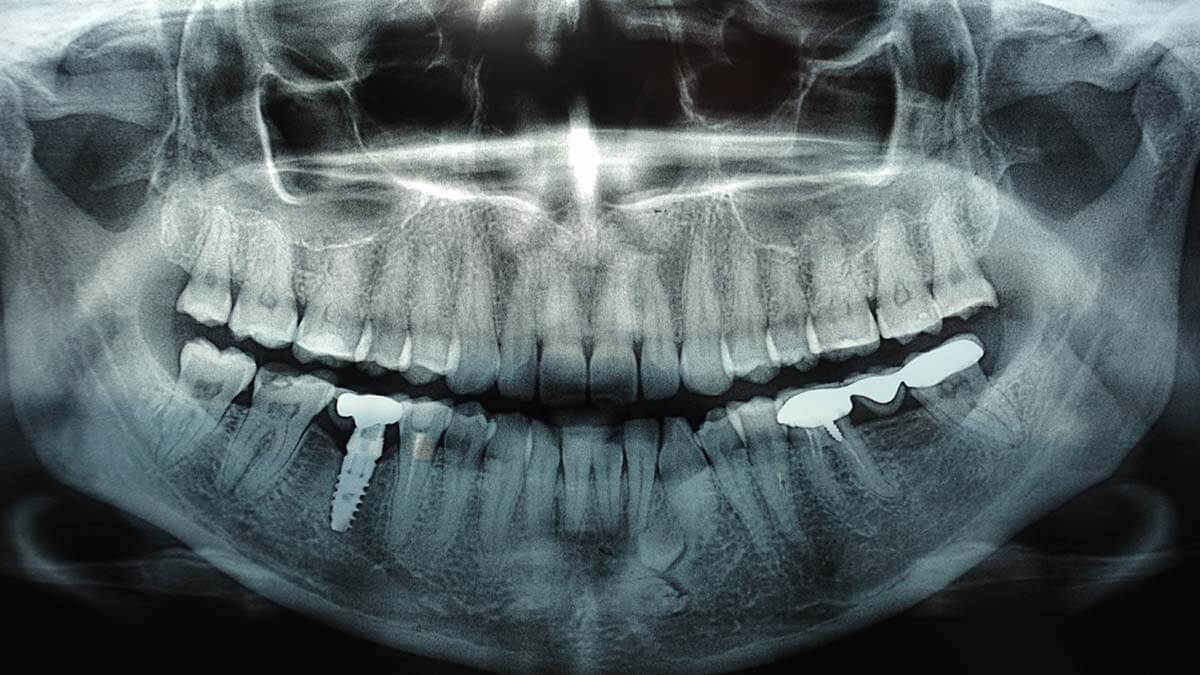 The Importance of Dental X-Rays for Oral Health: Insights from Vanilla Smiles Dental Clinic in Shivaji Nagar, Pune