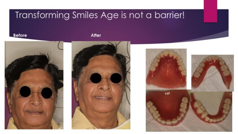 Complete Denture