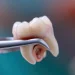 Wisdom Tooth Extraction In Pune