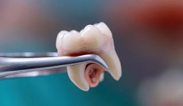 Wisdom Tooth Extraction: Comprehensive Guide to What to Expect & How to Prepare at Vanilla Smiles Dental Clinic, Shivaji Nagar, Pune