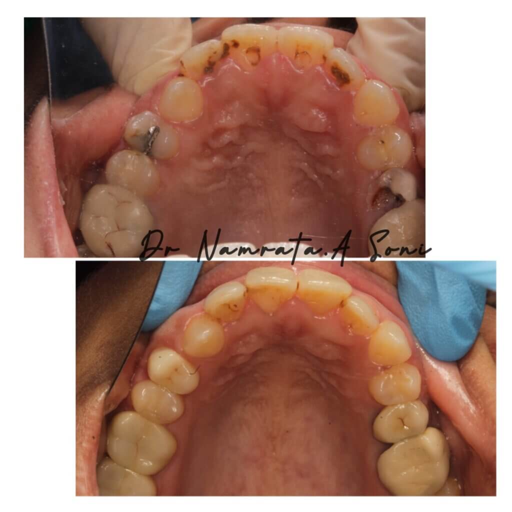 Full Mouth Rehabilitation