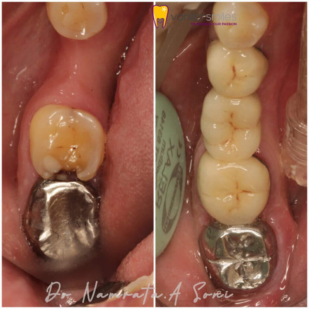 Missing Tooth replaced with a dental bridge