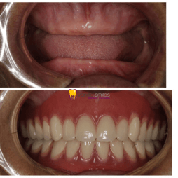 Complete Denture