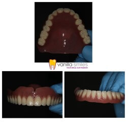 Complete Denture