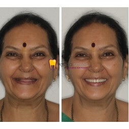 Complete Denture In Pune