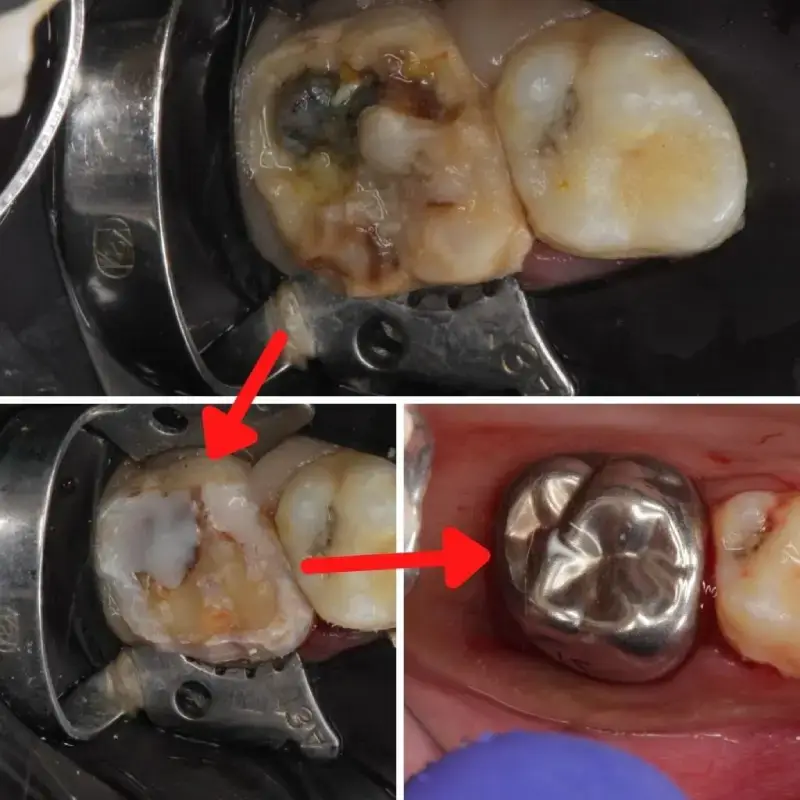 Hypominerlization Case