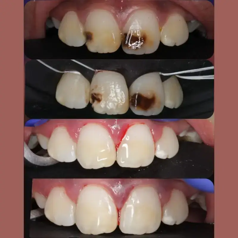 Molar Incisor vanilla