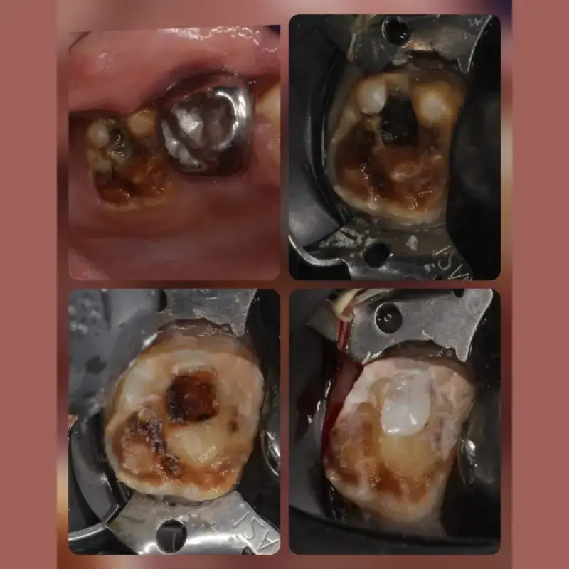 Hypominerlization Case 1