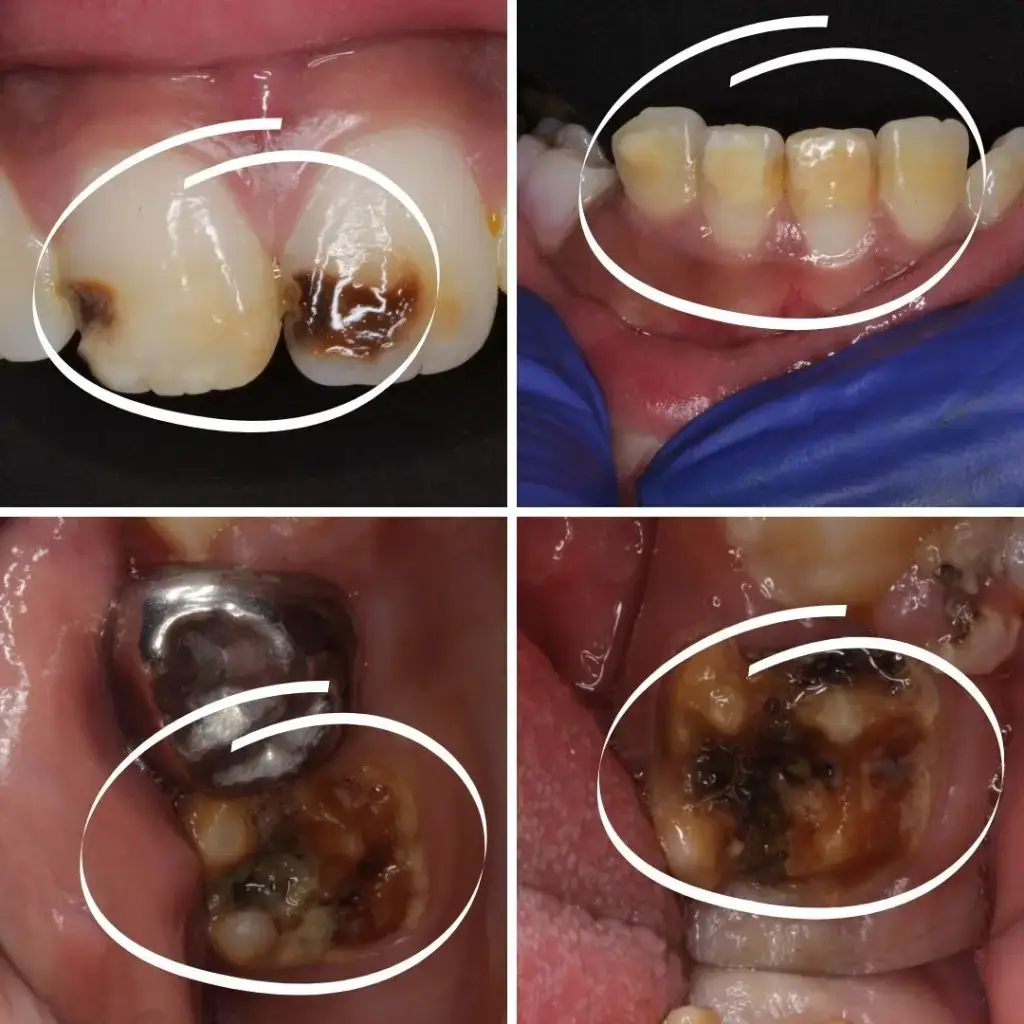 Molar Incisor