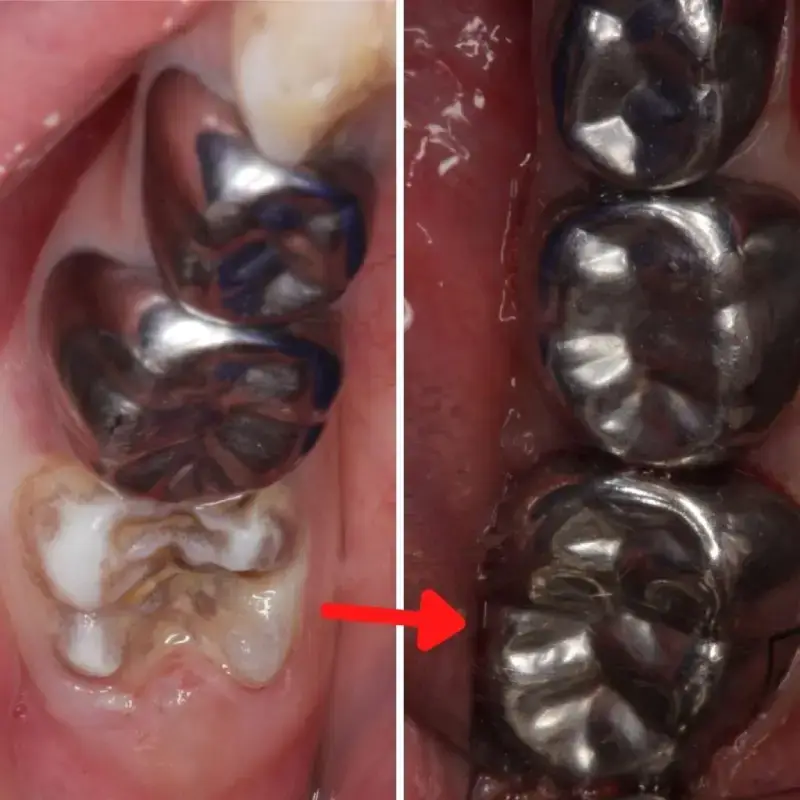 MIH Treatment - Tooth 2