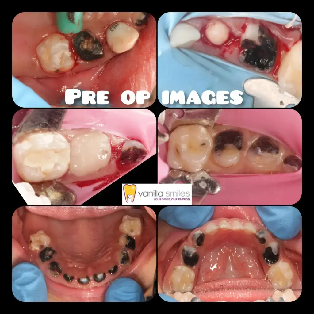 SDF Cavity Treatments In Shivaji Nagar