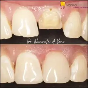 dental-crown-2