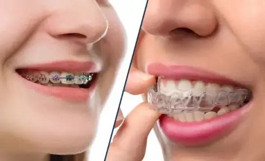 Invisalign In Pune