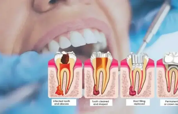 Saving Smiles: All About Root Canal Treatment at Vanilla Smiles Dental Clinic in Pune