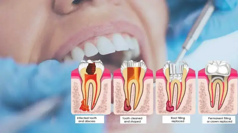 Saving Smiles: All About Root Canal Treatment at Vanilla Smiles Dental Clinic in Pune